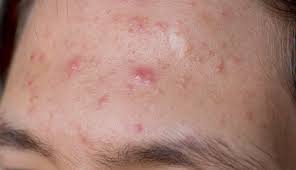 Dermatologie, focus sur les problèmes de peau les plus fréquents