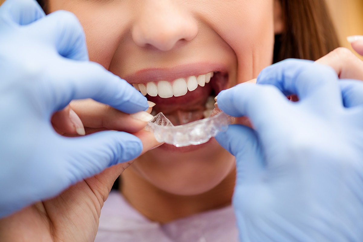 Quel est le niveau de remboursement de la parodontite ?